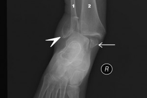 Fracture Risk for Type 1 Diabetics