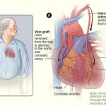 coronary artery bypass grafting surgery