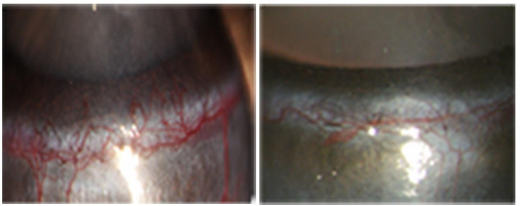 Secretogranin III induces the formation of blood vessels in the eye of a diabetic mouse (left) but has no effect on the eye of a healthy rodent (right).