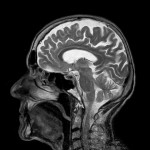 Brain Scan -- What is the Link Between Blood Sugar Levels and Brain Cancer