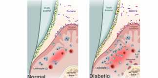 Diabetes shifts the oral microbiome