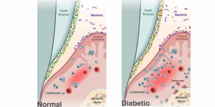Diabetes shifts the oral microbiome