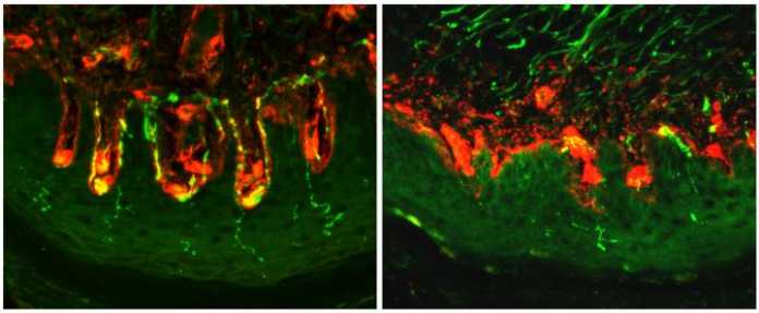 Source of Diabetic Pain Found