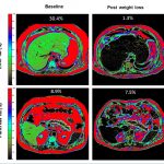 MRI Images of Liver and Pancreas Fat and Diabetes