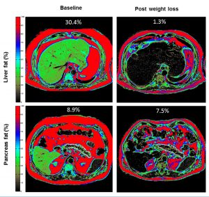 MRI Images of Liver and Pancreas Fat and Diabetes